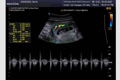 Una ecografía 5D puede detectar el latido fetal a las cuatro semanas de la fecundación, y con mayor claridad a partir de las seis semanas y media o siete semanas. Foto: Baby World Ultrasound.