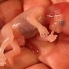 Noah murió por aborto natural, y ahora su imagen puede salvar miles de vidas.