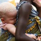 Los albinos en varios países africanos son asesinados o mutilados para vender partes de sus cuerpos para brujería