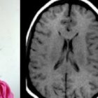 La lisencefalia consiste en la ausencia de pliegues cerebrales