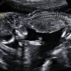 Feto de 14 semanas, edad gestacional a la cual la ley española permite matarlo libremente. Imagen: The Birth Company at the Portland Hospital.