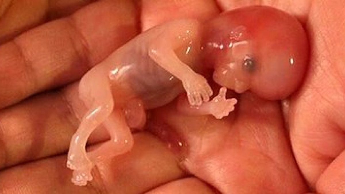 Noah murió por aborto natural, y ahora su imagen puede salvar miles de vidas.