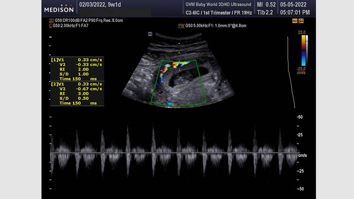 Una ecografía 5D puede detectar el latido fetal a las cuatro semanas de la fecundación, y con mayor claridad a partir de las seis semanas y media o siete semanas. Foto: Baby World Ultrasound.
