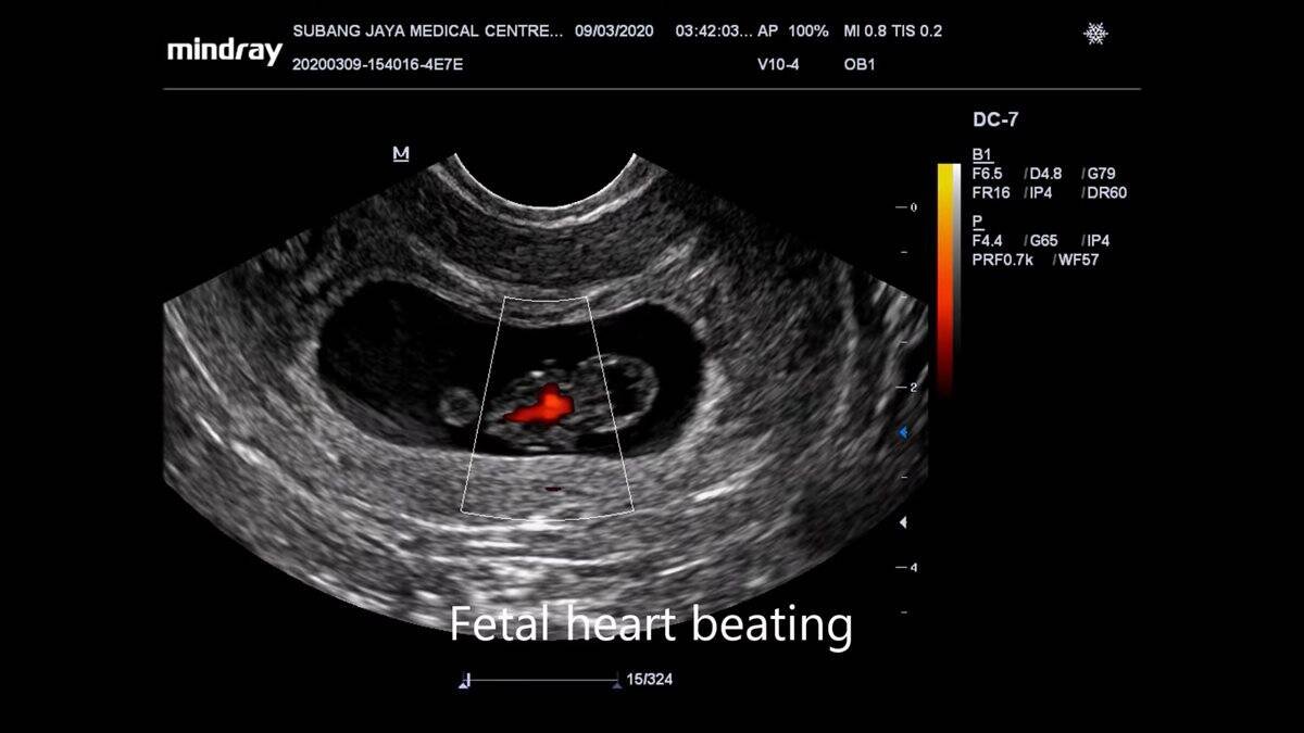 Ecografía de un embrión de 8 semanas, totalmente formado y con el latido del corazón perfectamente audible.